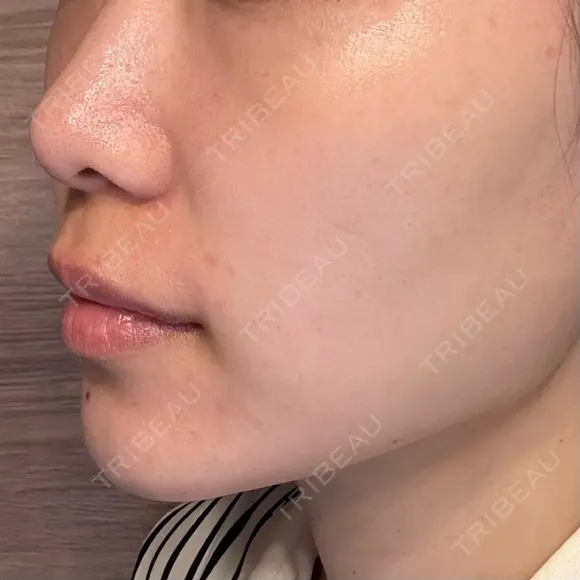 ピコレーザートーニング（美白・肝斑） PICO BEAUTY CLINIC DAY 0 メイン用