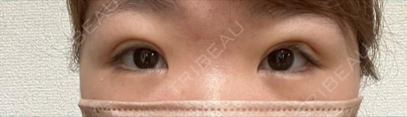 二重埋没 / クマ治療 NARU Beauty Clinic 【ナルクリ】 DAY 11 メイン用