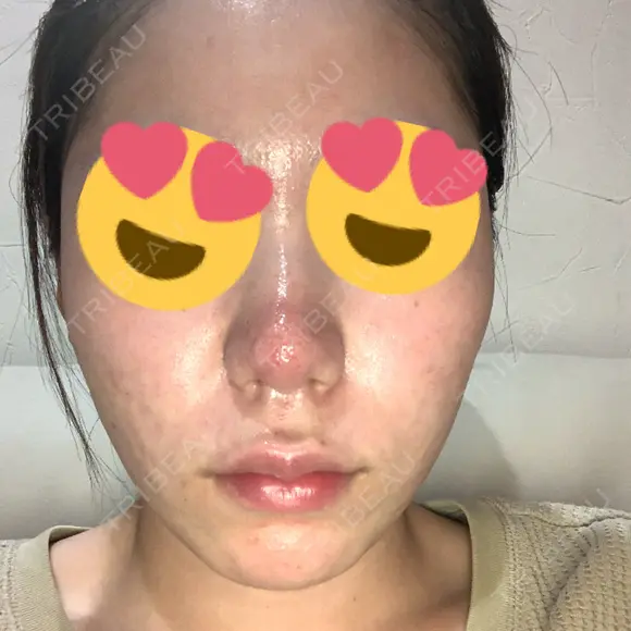 ポテンツァ レナータクリニック 立川院 DAY 11 メイン用