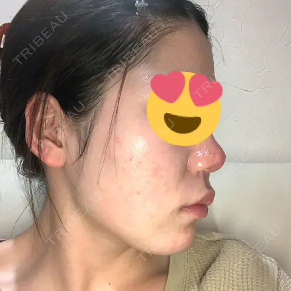 ポテンツァ レナータクリニック 立川院 DAY 11 メイン用