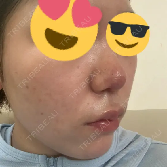 ポテンツァ レナータクリニック 立川院 AFTER メイン用