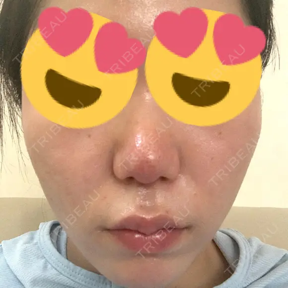 ポテンツァ レナータクリニック 立川院 DAY 20 メイン用