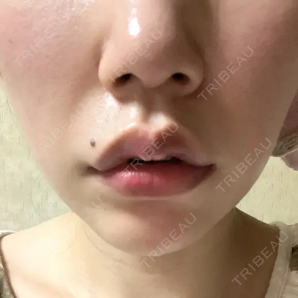 口角挙上 宇都宮竹内クリニック DAY 8 メイン用