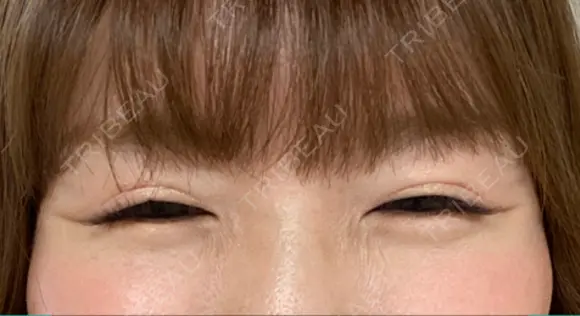 ボトックス（目尻） TCB東京中央美容外科 大宮東口院 AFTER メイン用
