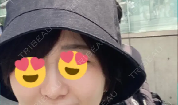 ヒアルロン酸注入（鼻） 青山外苑前クリニック DAY 4 メイン用