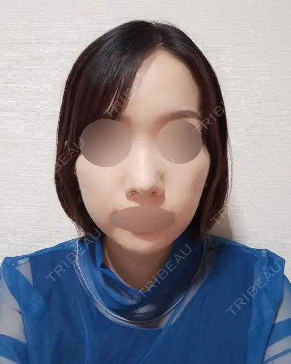 鼻中隔延長（切開） / 小鼻縮小（切開） / あごプロテーゼ ビーザニュー美容整形外科（旧コノピ美容整形外科） DAY 31 メイン用