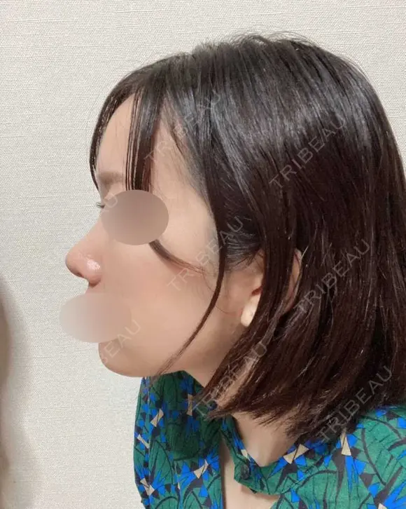 鼻中隔延長（切開） / 小鼻縮小（切開） / あごプロテーゼ ビーザニュー美容整形外科（旧コノピ美容整形外科） AFTER メイン用