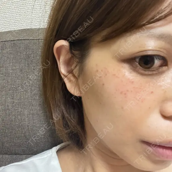 毛穴洗浄（ハイドラフェイシャルなど） / 光治療（フォトフェイシャルなど） まゆりなclinic 名古屋栄 DAY 0 メイン用