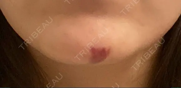 ヒアルロン酸注入（あご） 麻布十番クレールデンタルクリニック DAY 12 メイン用