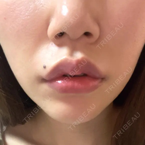 口角挙上 宇都宮竹内クリニック DAY 12 メイン用