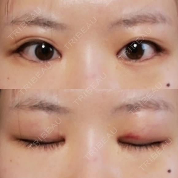 目頭切開 / 目尻切開 / 水光注射（ハリ・美肌） エートップ美容整形外科 DAY 19 メイン用