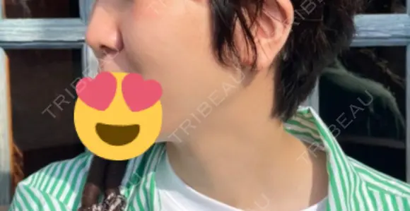 ヒアルロン酸注入（鼻） 青山外苑前クリニック DAY 20 メイン用