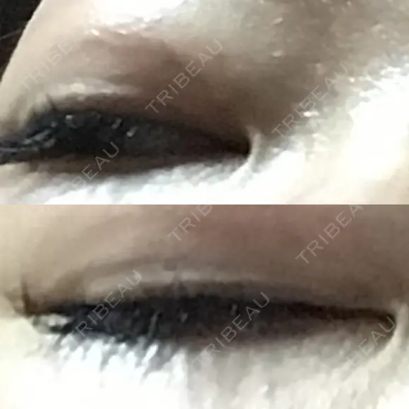 二重埋没 Olino美容外科・美容皮膚科 AFTER メイン用