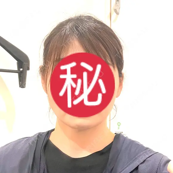 その他（輪郭） / 医療痩身（顔） WOM CLINIC GINZA （ワム クリニック ギンザ） AFTER メイン用