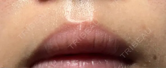 医療脱毛（顔） 美容皮膚科エルムクリニック 京都院 AFTER メイン用