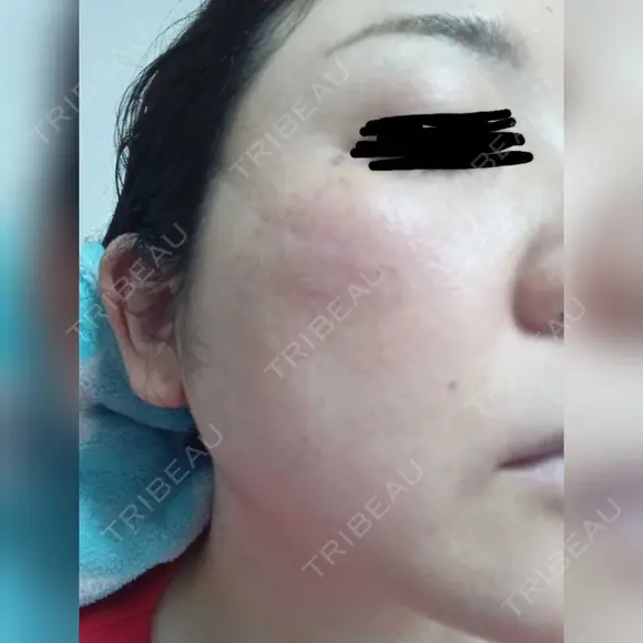 エレクトロポレーション / 光治療（フォトフェイシャルなど） S.T styleクリニック DAY 0 メイン用