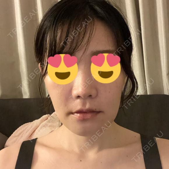 セットバック カトレア歯科・美容クリニック DAY 7 メイン用