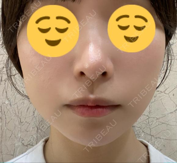 ボトックス（エラ・小顔） KARIS beauty clinic AFTER メイン用
