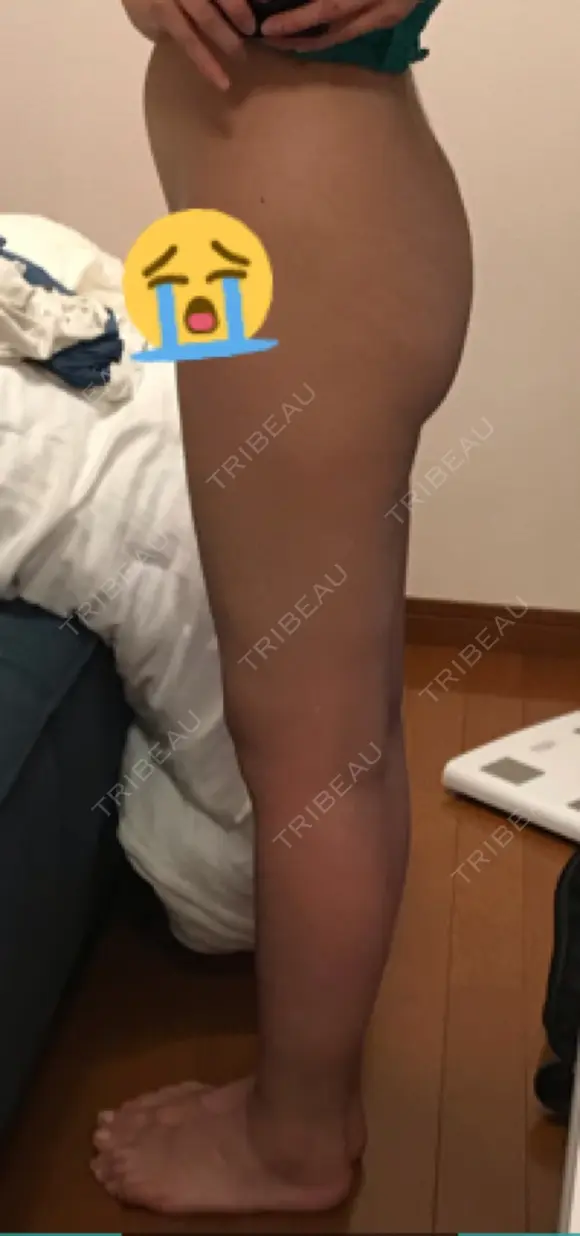 脂肪吸引（脚） / 脂肪吸引（お尻） ヨンセスリムライン DAY 26 メイン用