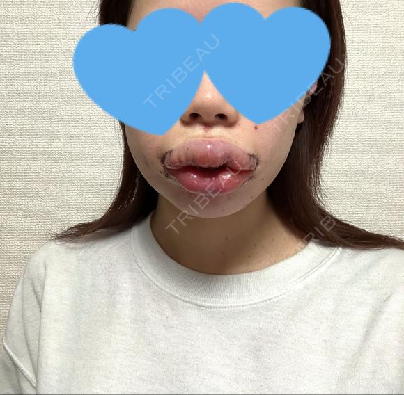 脂肪吸引（顔） / 口唇縮小術 / 口角挙上 / ジョールファット除去 / ヒアルロン酸注入（あご） / ボトックス（エラ・小顔） / ボトックス（口角） Otus Clinic 【オータスクリニック】 DAY 3 メイン用