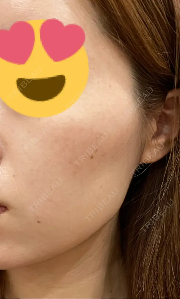 ピーリング（ニキビ・毛穴） / イオン導入 渋谷美容外科クリニック 新橋院 DAY 2 メイン用