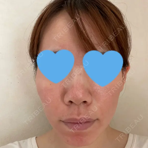 ヴェルヴェットスキン KOBE美容皮膚科 神戸東灘院 DAY 1 メイン用
