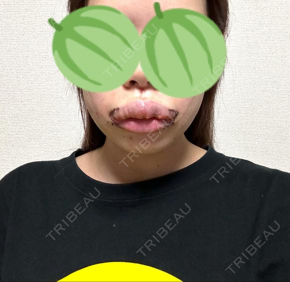 脂肪吸引（顔） / 口唇縮小術 / 口角挙上 / ジョールファット除去 / ヒアルロン酸注入（あご） / ボトックス（エラ・小顔） / ボトックス（口角） Otus Clinic 【オータスクリニック】 DAY 5 メイン用