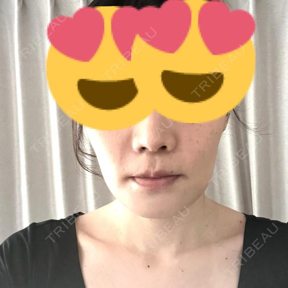 セットバック カトレア歯科・美容クリニック DAY 14 メイン用