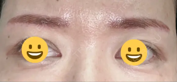 アートメイク（眉） メディカルアートメイク大阪 DAY 3 メイン用