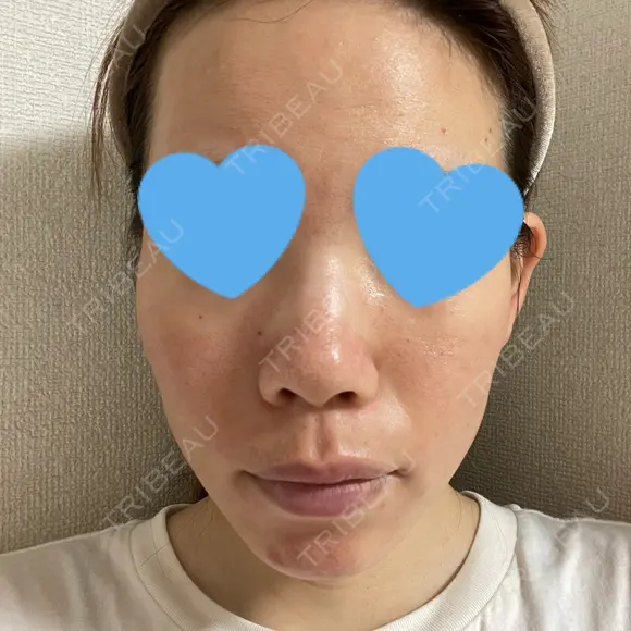 ヴェルヴェットスキン KOBE美容皮膚科 神戸東灘院 DAY 3 メイン用