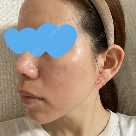 ヴェルヴェットスキン KOBE美容皮膚科 神戸東灘院 DAY 3 メイン用
