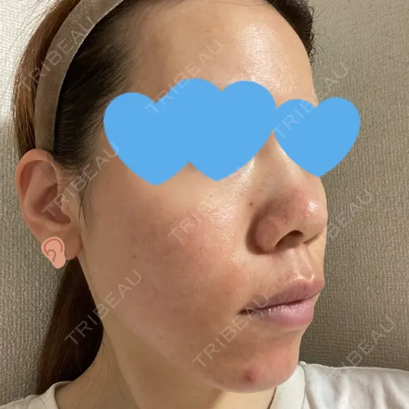 ヴェルヴェットスキン KOBE美容皮膚科 神戸東灘院 DAY 3 メイン用