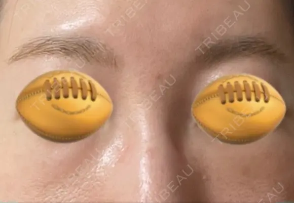 下まぶたの脂肪取り あじまビューティークリニック DAY 1 メイン用