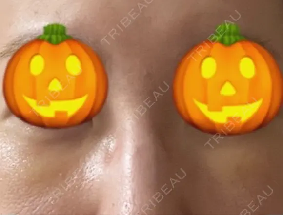 下まぶたの脂肪取り あじまビューティークリニック DAY 2 メイン用