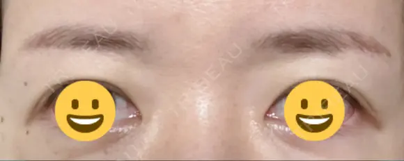 アートメイク（眉） メディカルアートメイク大阪 DAY 6 メイン用