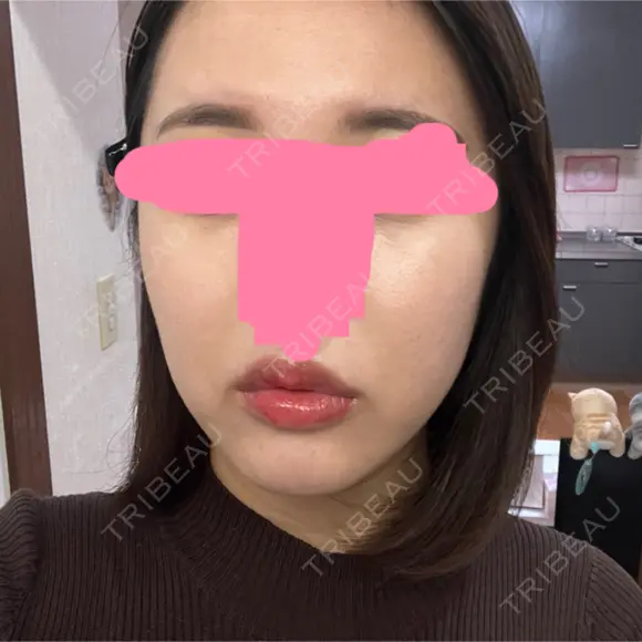 ヒアルロン酸注入（唇） / ボトックス（口角） / ヒアルロン酸注入（頬） KAGA CLINIC AFTER メイン用