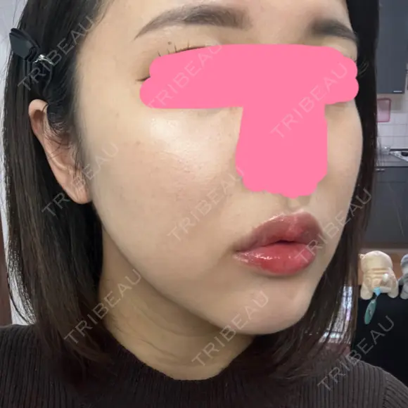 ヒアルロン酸注入（唇） / ボトックス（口角） / ヒアルロン酸注入（頬） KAGA CLINIC DAY 9 メイン用