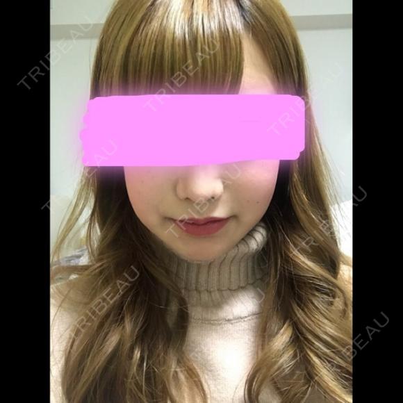 骨削り（エラ） / 骨削り（頬） / その他（輪郭） / 目尻切開 / タレ目形成・グラマラスライン（切開） / 輪郭修正 ウォンジン（Wonjin）整形外科 DAY 26 メイン用