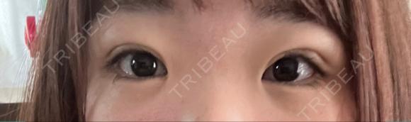 二重埋没 / クマ治療 NARU Beauty Clinic 【ナルクリ】 DAY 20 メイン用
