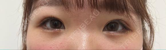 二重埋没 / クマ治療 NARU Beauty Clinic 【ナルクリ】 AFTER メイン用