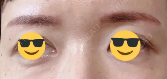 アートメイク（眉） メディカルアートメイク大阪 DAY 0 メイン用