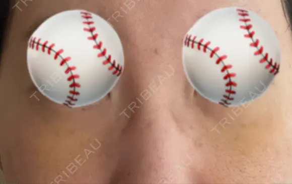 下まぶたの脂肪取り あじまビューティークリニック DAY 3 メイン用