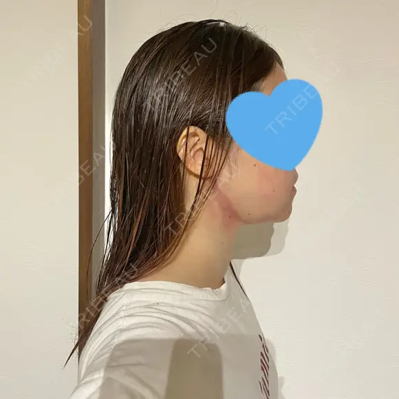 脂肪吸引注射（顔） 湘南美容クリニック 秋葉原院 DAY 0 メイン用