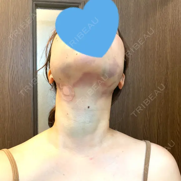 脂肪吸引注射（顔） 湘南美容クリニック 秋葉原院 DAY 0 メイン用