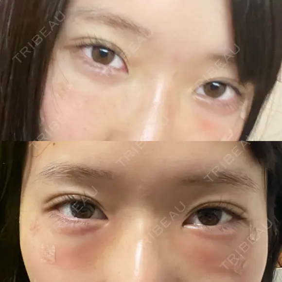 クマ治療 X CLINIC 銀座院 DAY 1 メイン用