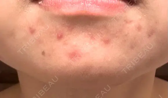 その他（肌） / ニードルRF（ポテンツァなど） KM新宿クリニック DAY 1 メイン用