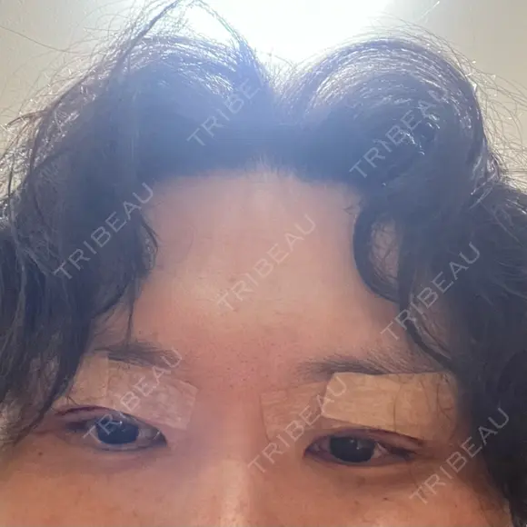 眼瞼下垂（切開） シェリークリニック 福岡院 DAY 0 メイン用