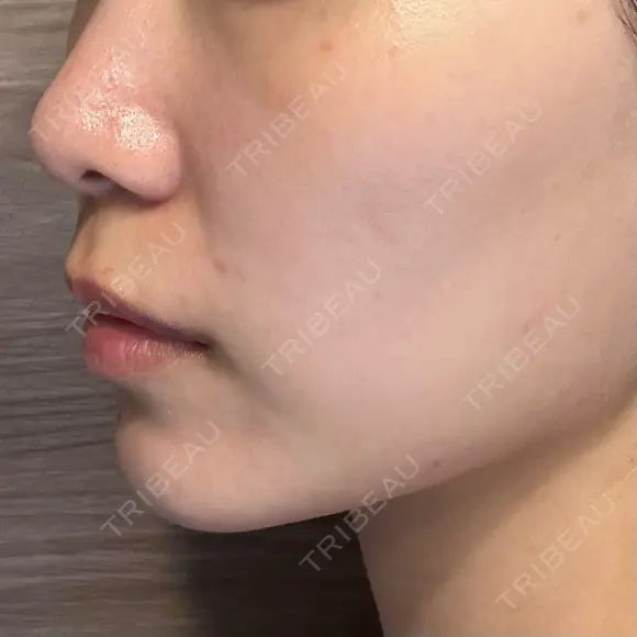 ピコレーザートーニング（美白・肝斑） PICO BEAUTY CLINIC AFTER メイン用