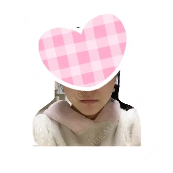 バッカルファット除去 / 脂肪吸引（顔） / ヒアルロン酸注入（涙袋） / ヒアルロン酸注入（鼻） / ヒアルロン酸注入（あご） / ボトックス（エラ・小顔） エートップ美容整形外科 DAY 19 メイン用