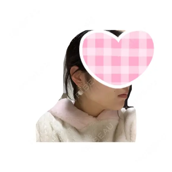 バッカルファット除去 / 脂肪吸引（顔） / ヒアルロン酸注入（涙袋） / ヒアルロン酸注入（鼻） / ヒアルロン酸注入（あご） / ボトックス（エラ・小顔） エートップ美容整形外科 DAY 19 メイン用